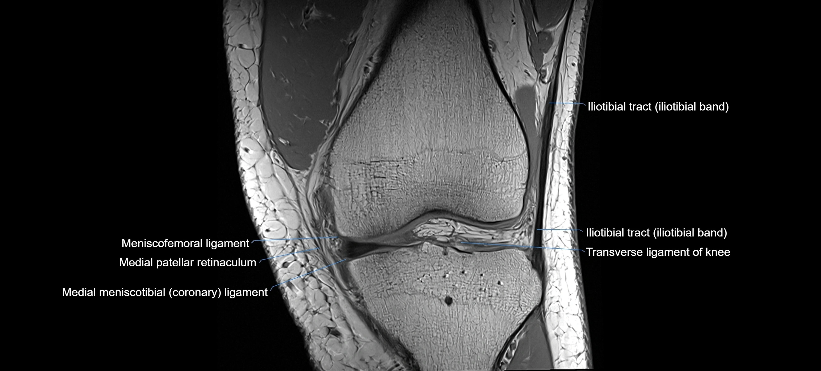 MRI coronal  ligaments cross sectional anatomy 3T  radiology  image-img-04001-00015.webp